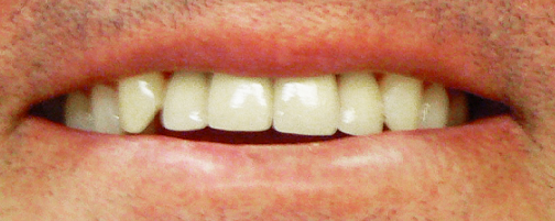 cosmetic-dentistry-services-after