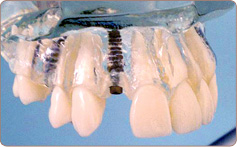 A demonstration of the Implant Crown mechanism in a "see through" model of a human mouth.