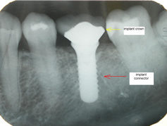 This dental x-ray shows how an implant crown and connector work with the implant connector anchored firmly in the tooth socket but completely covered by the implant crown.